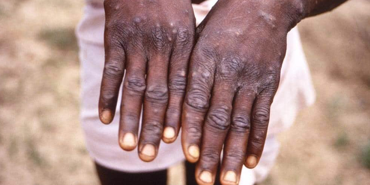 La variole du singe : quelle est cette nouvelle épidémie dont on doit se méfier ?
