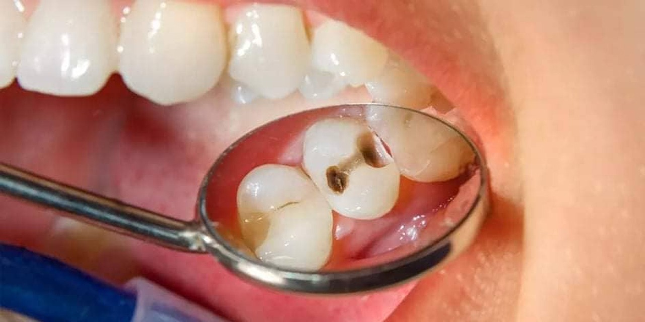 Carie dentaire: Comment prévenir et soigner?